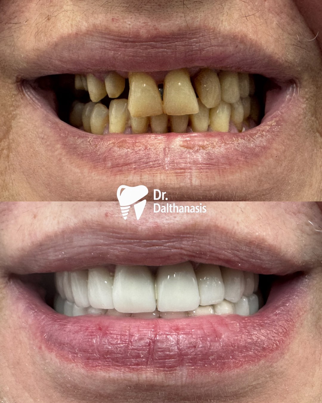 Smile makeover Larisa — natural cosmetic dentistry results